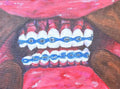 Artistic depiction of a mouth with braces 
