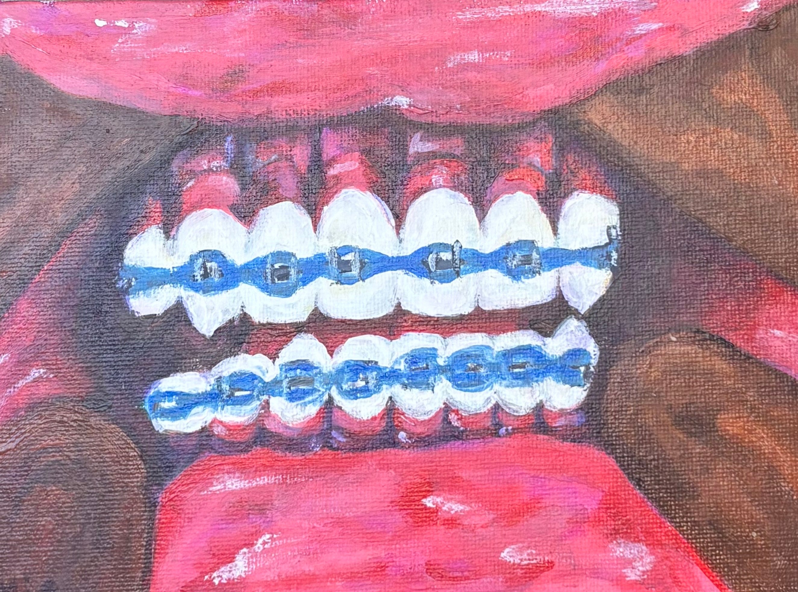 Artistic depiction of a mouth with braces 